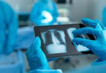 Credea că are o boală de plămâni dar de fapt, avea un prezervativ în plămâni radiografie plamani