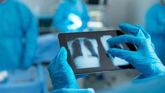 radiografie radiografie plamani